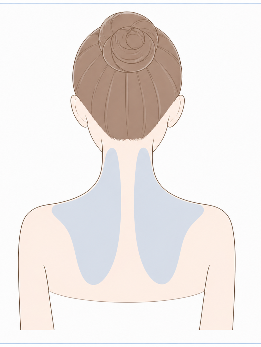 肩ボトックス（僧帽筋）施術部位イラスト