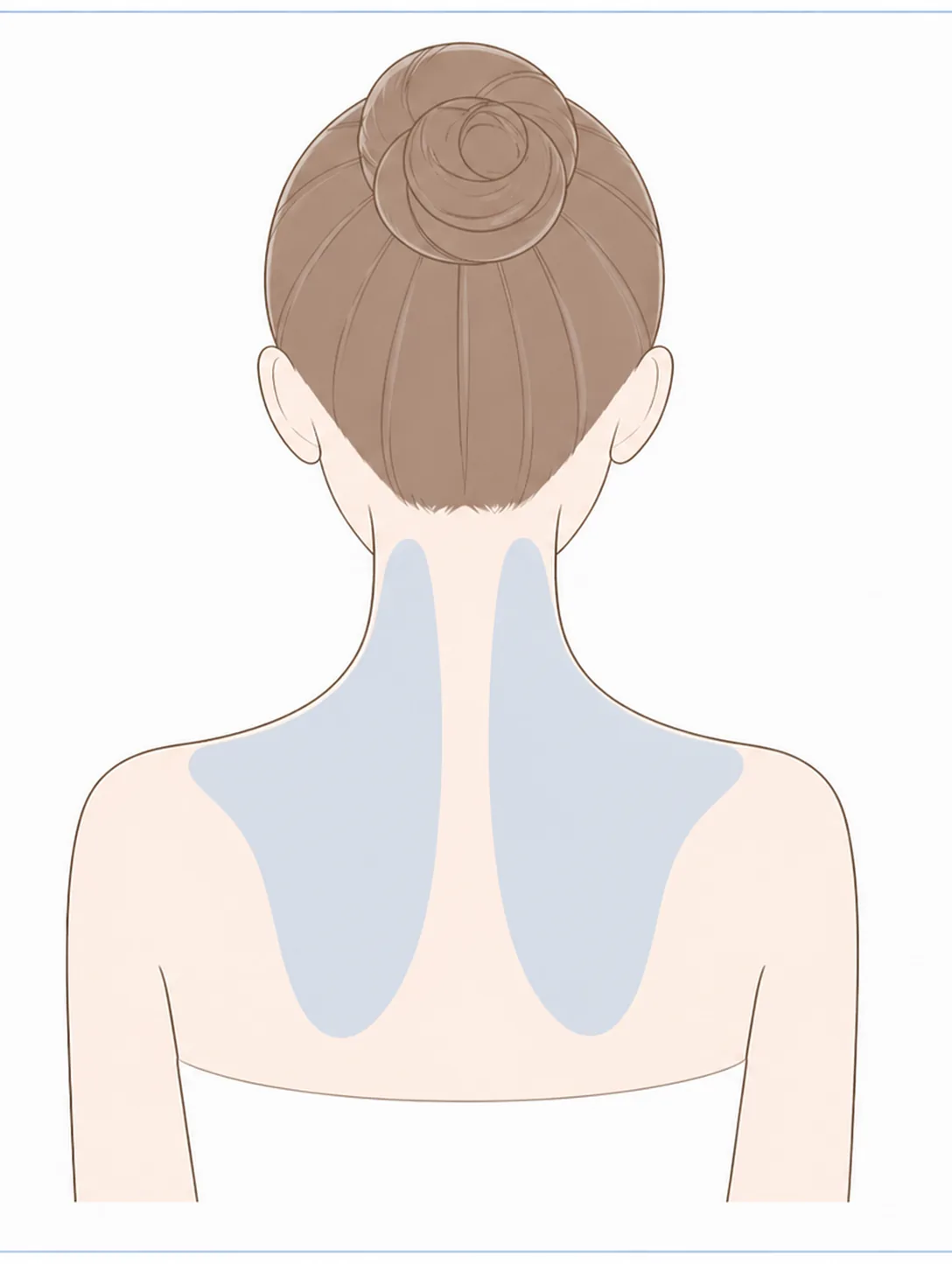 肩ボトックス（僧帽筋）の施術部位イラスト