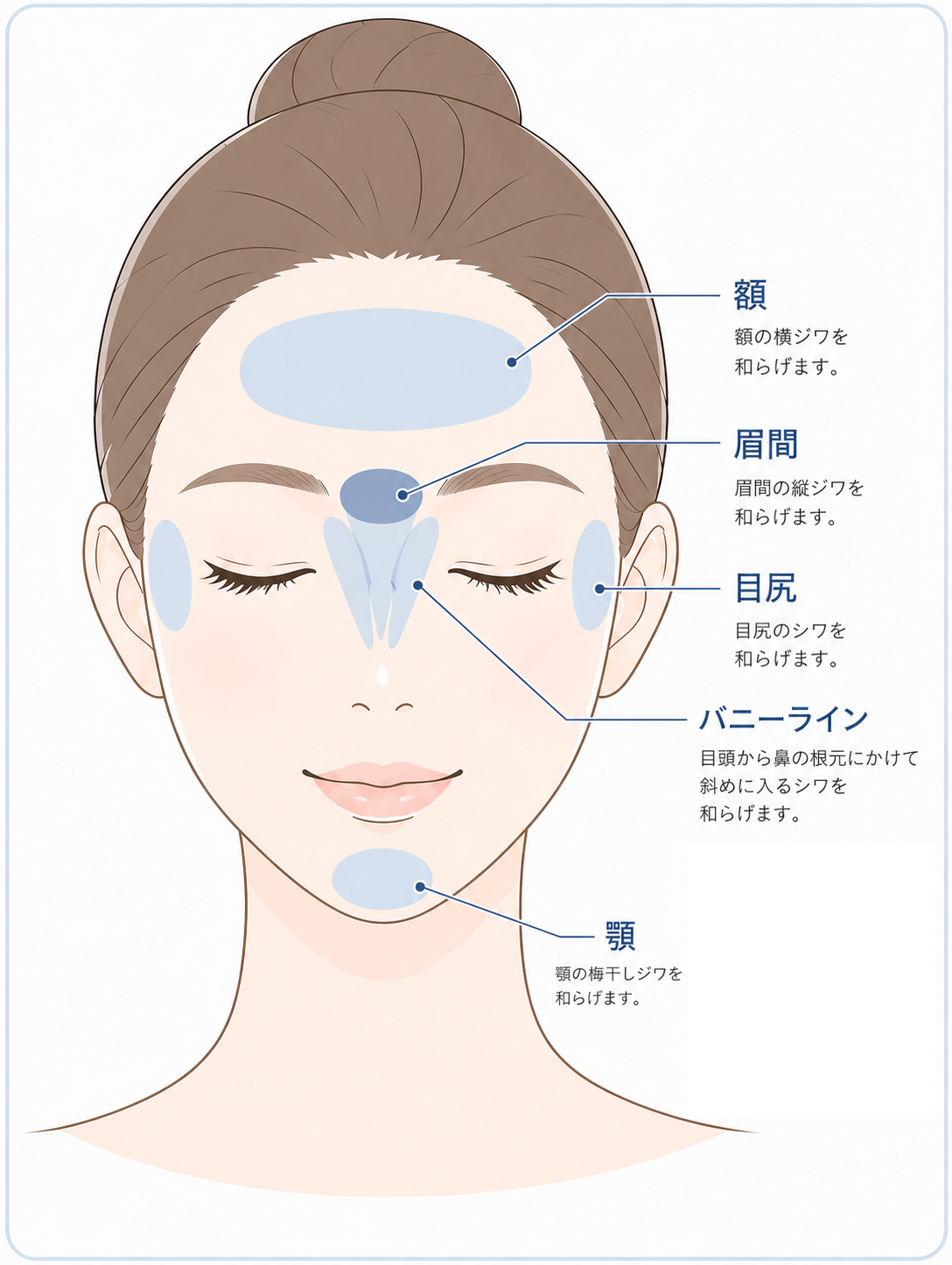 表情じわのボトックス治療のイラスト