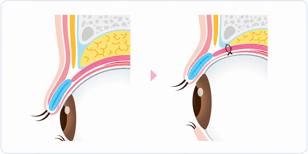 切らない眼瞼下垂手術の説明イラスト