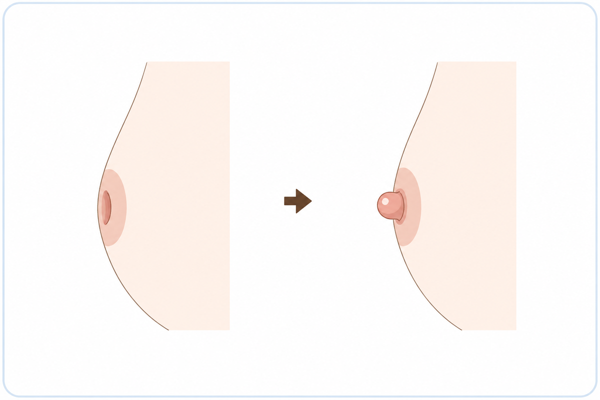乳頭・乳輪形成のイラスト