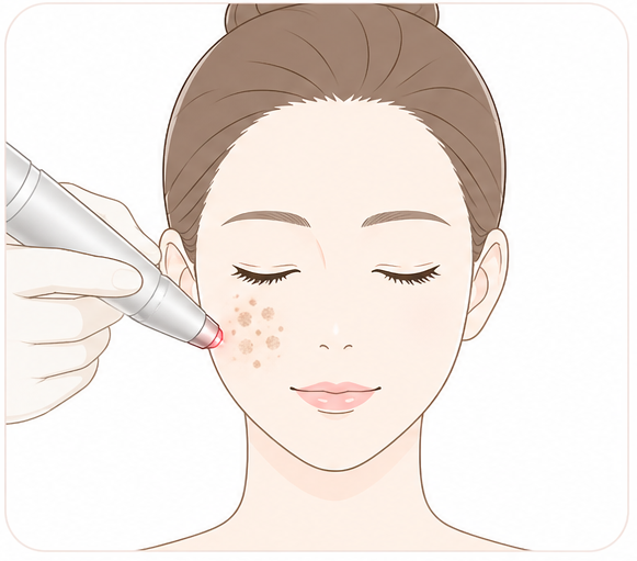 シミ取りレーザー・色素治療のイラスト