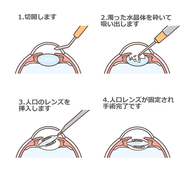 白内障手術の手順イラスト|切開・水晶体除去・眼内レンズ挿入・手術完了の4ステップ