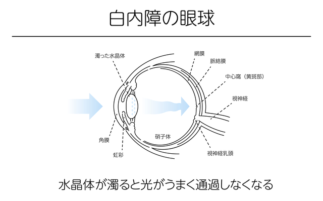 白内障の眼球