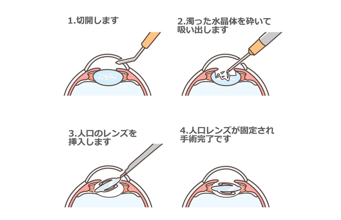 白内障が進行した段階のイメージ