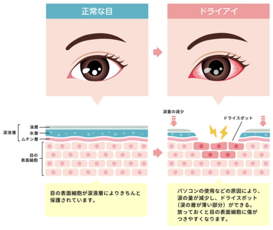 ドライアイのメカニズム