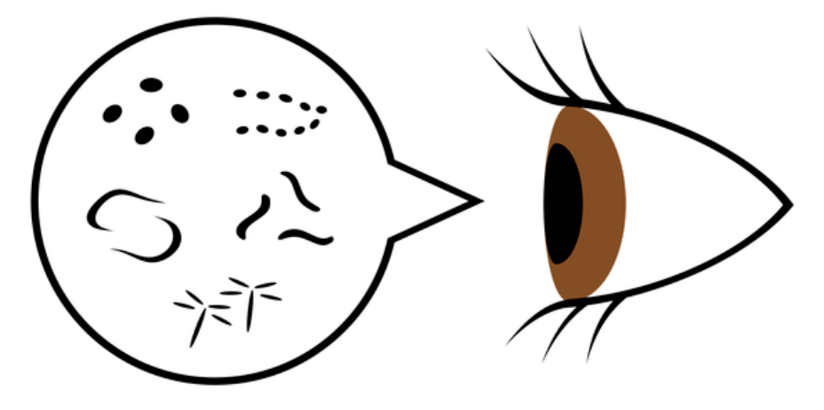 飛蚊症の見え方