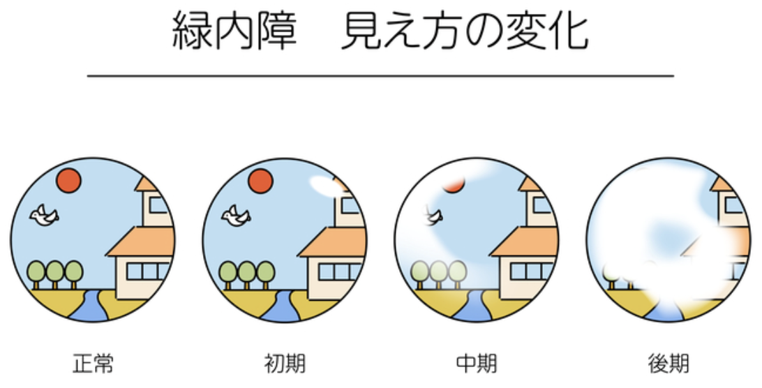 緑内障の見え方
