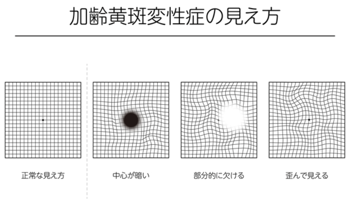 加齢黄斑変性の見え方