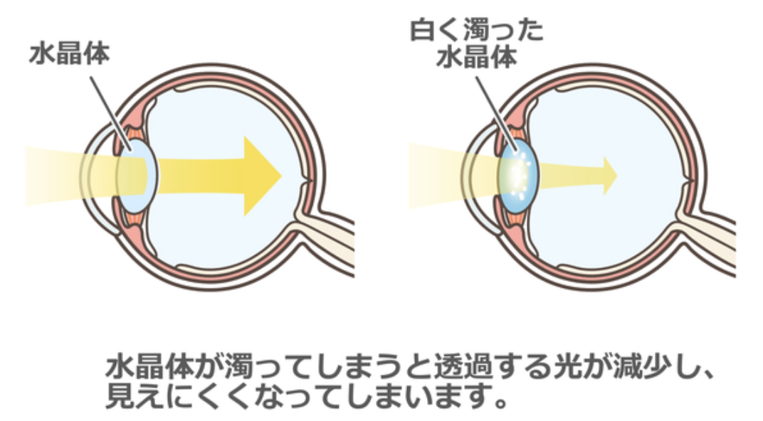 白内障のメカニズム