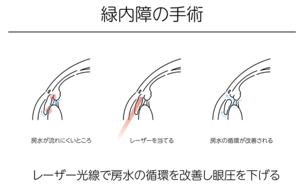 緑内障の治療法