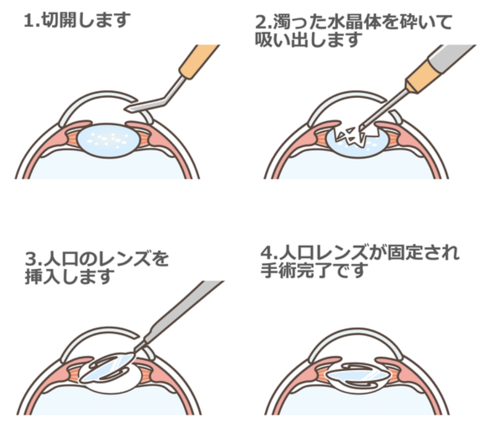 白内障の手術方法