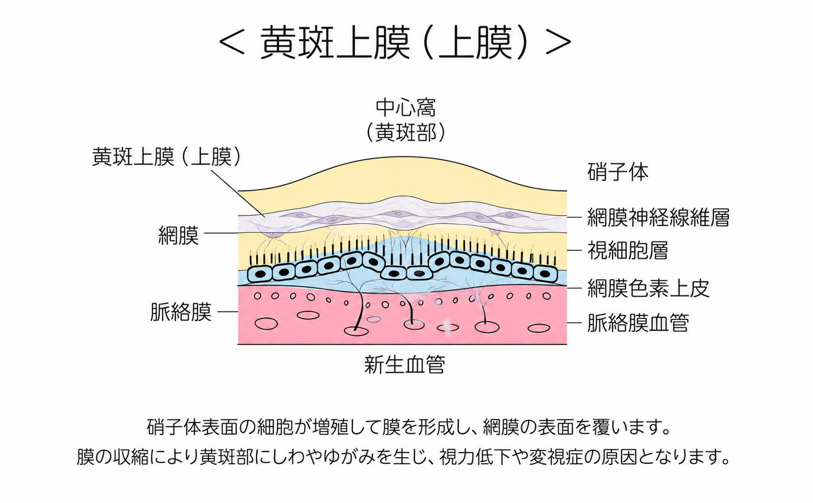 黄斑上膜（上膜）の断面解説図：網膜表面に薄い膜が形成された状態