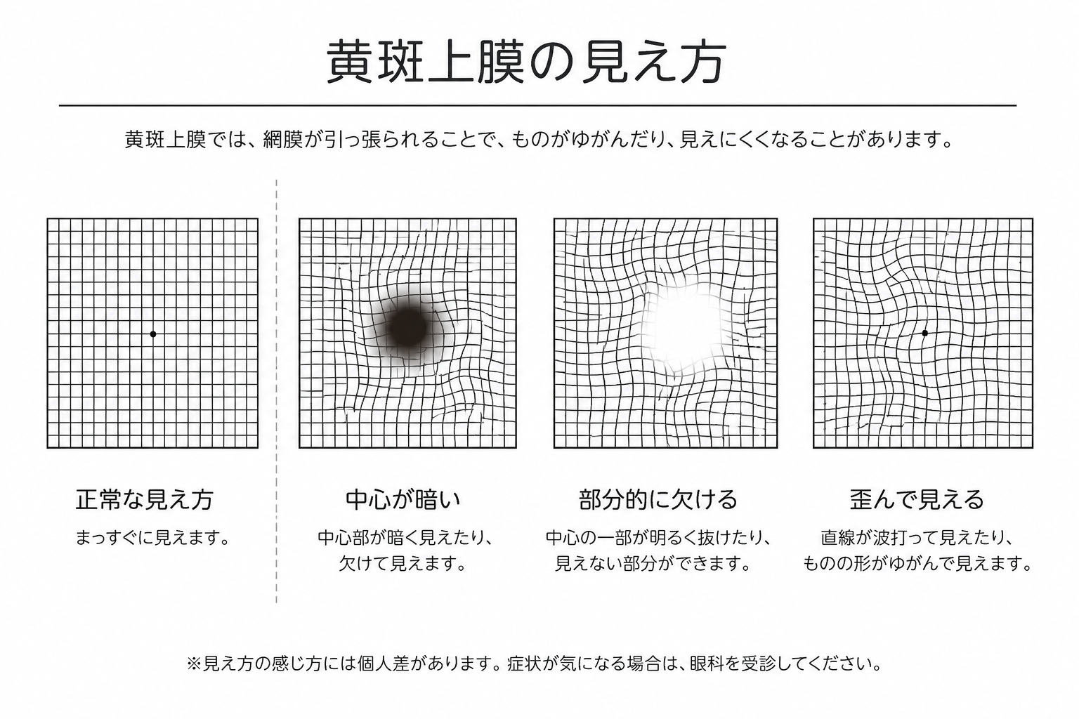 黄斑上膜の見え方の比較図：正常・中心が暗い・部分的に欠ける・歪んで見える